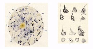 Alzheimer's plaques and tangles